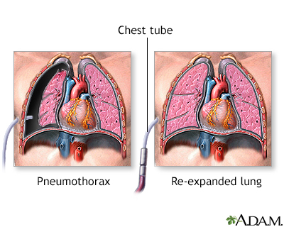 Collapsed Lung Pneumothorax