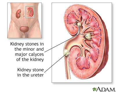 Kidney Stones