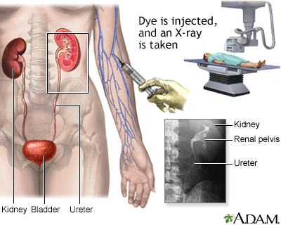 Urinary Tract Infection