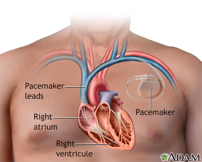 Can Your Heart Skip A Beat With A Pacemaker Heart Pacemaker Discharge