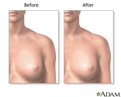 breast reconstruction after a lumpectomy