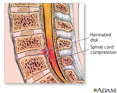 Herniated disk